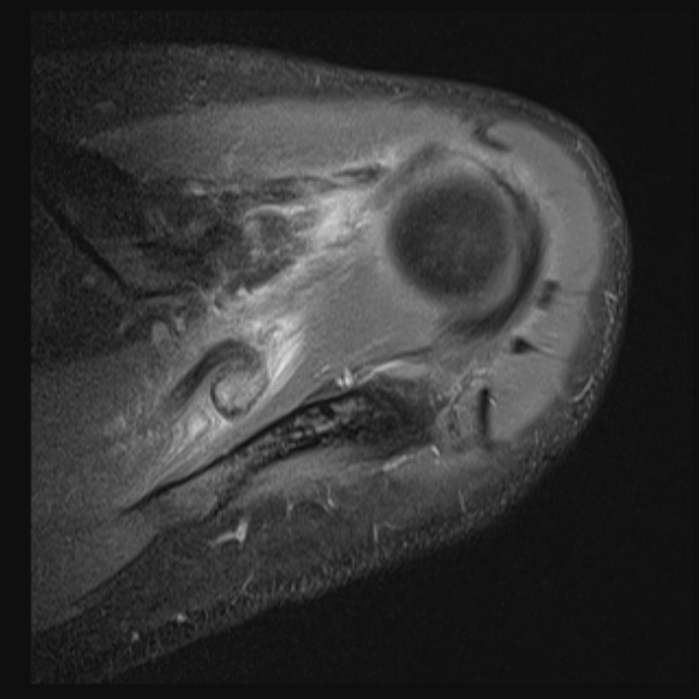 Figure 6 for case Massive interstitial delamination of Supraspinatus with retraction